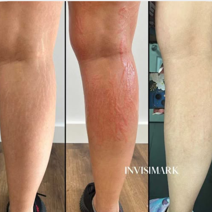 Traitement goudron fard vergetures